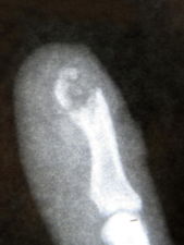 SmashedFingerXRay2.jpg