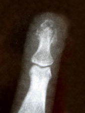 SmashedFingerXRay1.jpg